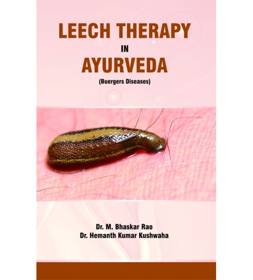 Leech Therapy in Ayurveda (Buergers Diseases)